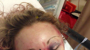 Ms Dronfield was left with a swollen face, bleed on the brain and a stab wound among other injuries